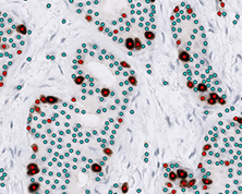 BreastIHC - Robust Ki-67, ER and PR quantification for breast cancer