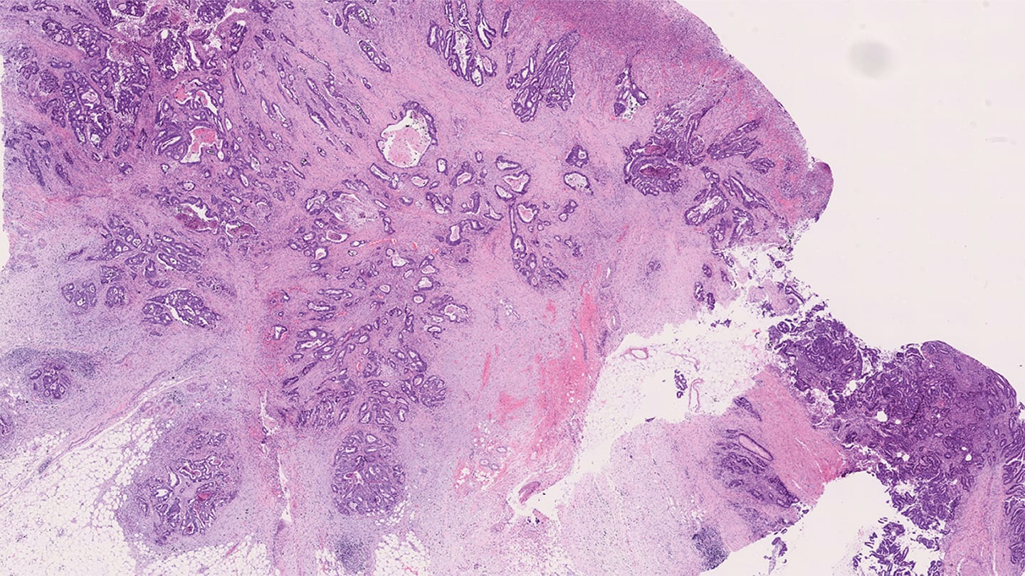 Biomarker Boost for Clinical Decision Making