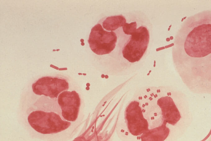 Gonorrhea: A Rising Resistance