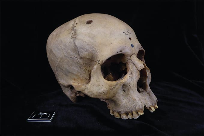 Palaeopathological Insights into Egyptian Cancer Cases