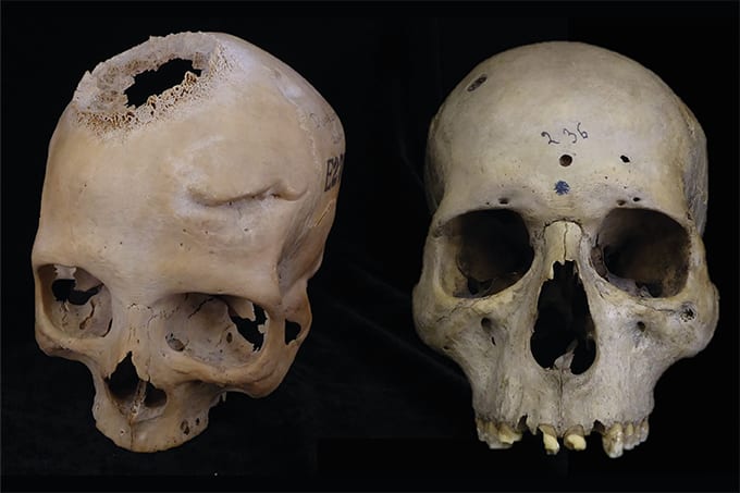 Palaeopathology at the Double