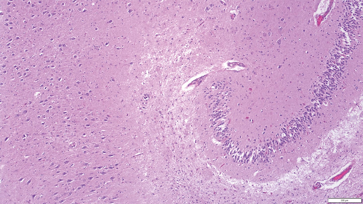 Rethinking “Asymptomatic” in Brain Autopsies