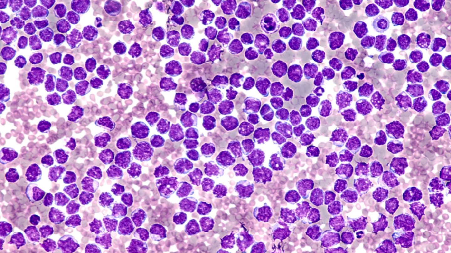 New Insights on BTKi, Venetoclax Failure