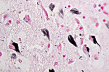 Alzheimer’s Analytics