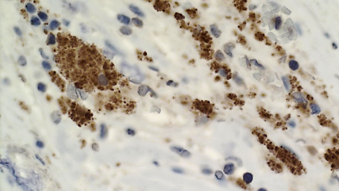 Are Heart Attacks Actually Infections