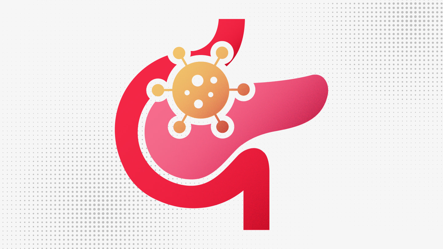 Cracking Pancreatic Cancers Diagnostic Code