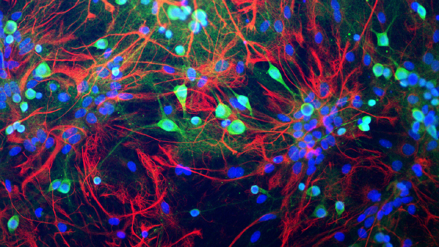 Stem Cell Study Uncovers Glial Cells That Accelerate Progressive MS