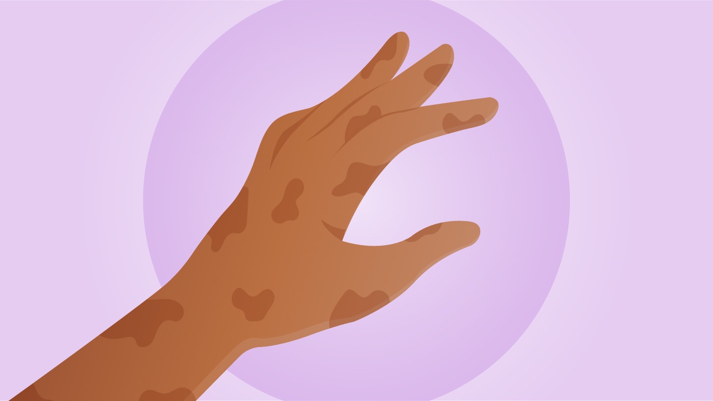 Hidden Leprosy Cases Uncovered