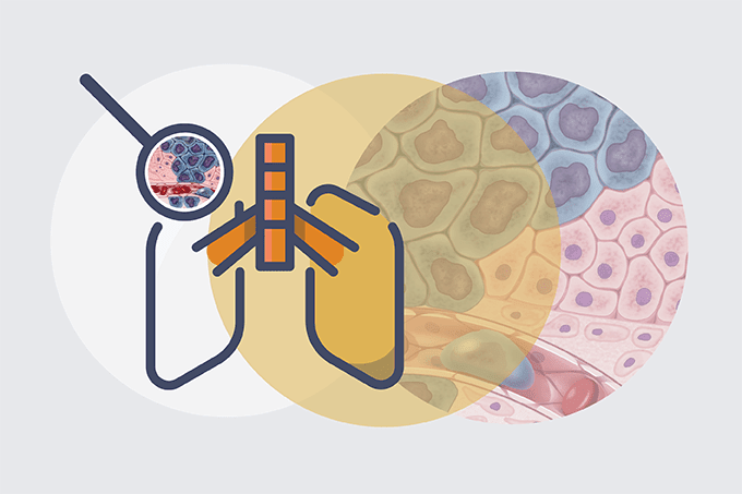 Lung Cancer Collaboration