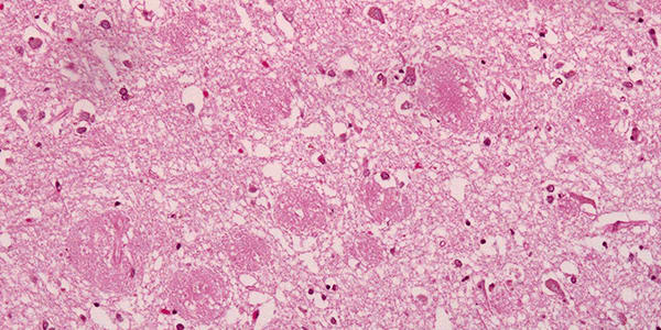 Positive Results in Alzheimer’s Trial