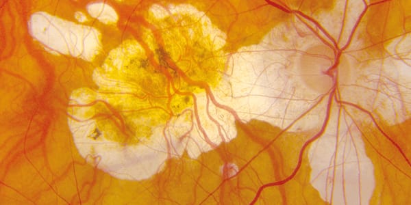 Global Ophthalmology