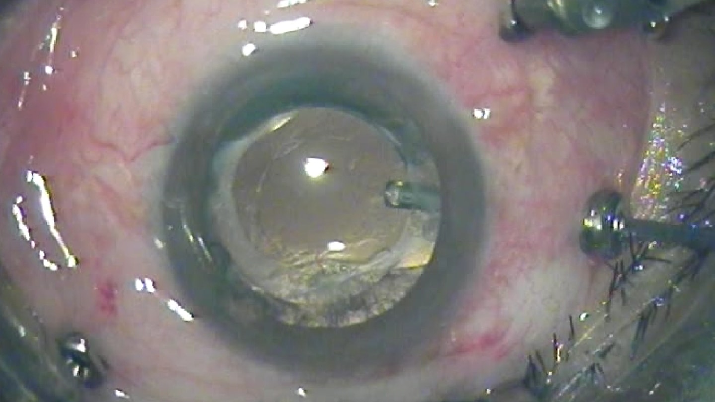 Endophthalmitis: A Case for Acting Early