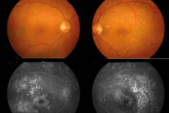 Diabetic Macular Edema (DME): See the Person Behind the Eye