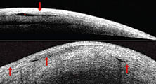 Cataract Surgery in Patients with Blebs: Seven Tips for Success