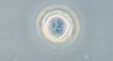 Acanthamoeba Ate my Eyeballs