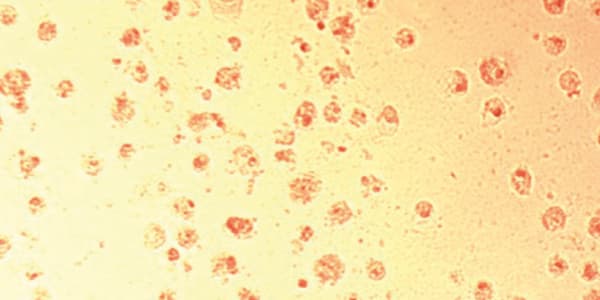 From Liposuction to New Stromal Collagen Production