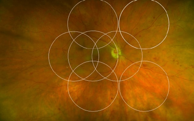 Retinal Imaging: The Big Picture