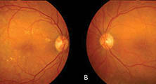 Recurrent Diabetic Macular Edema: What to Do?