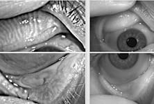 Case Study on a Dry Eye Patient: Keratograph 5M Topographer with additional features