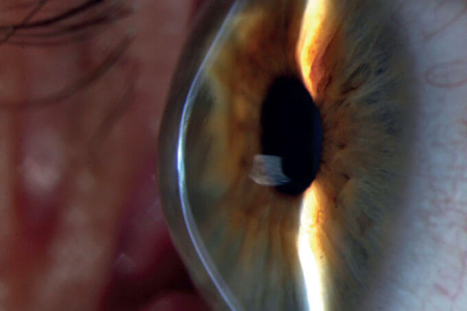 Keratoconus: Are the Earliest Warning Signs in our Genes?