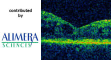 Clinical Experience with the Fluocinolone Acetonide Intravitreal Implant for Chronic Diabetic Macular Edema