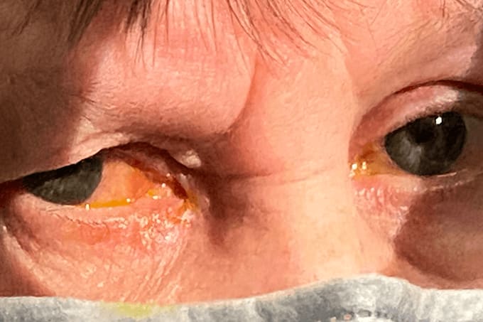 Finding Ocular Surface Inflammation