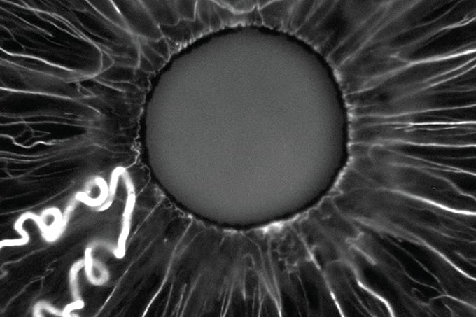 Anomalous iris vessel