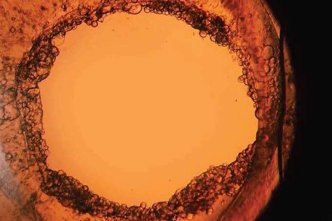 Crystal Clear Capsulotomy