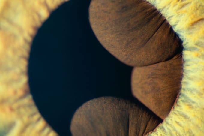 Iris Cysts