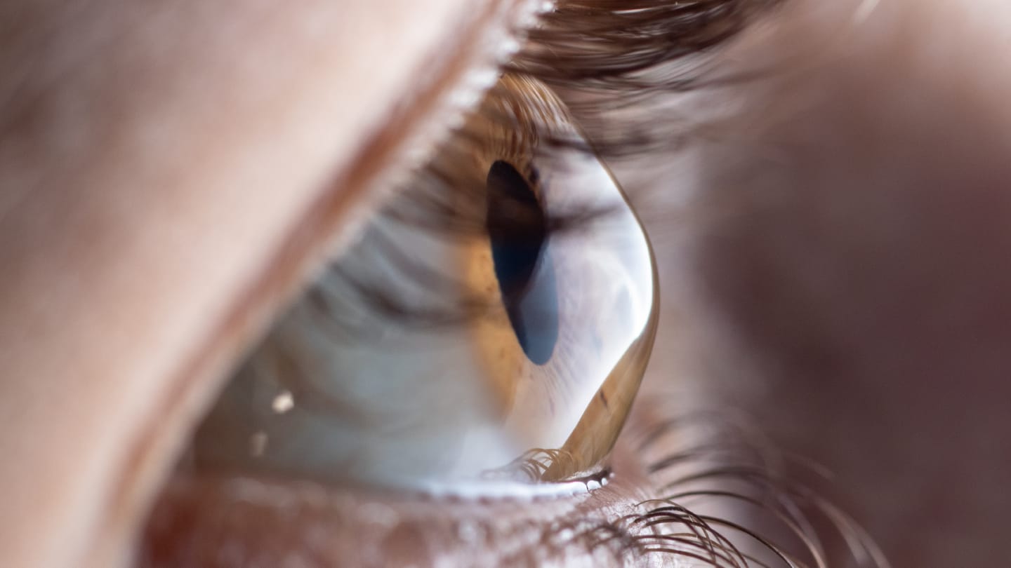 Keratoconus in Hormonal Flux