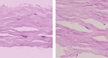 Small Incision Femtosecond Refractive Lenticule Assisted CXL in Corneal Ectasia