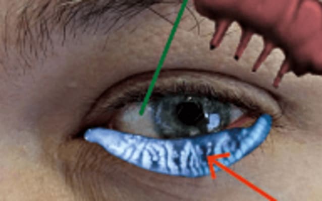 The Burden of Dry Eye Disease