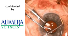 Repositioning ILUVIEN® (fluocinolone acetonide) from the anterior chamber