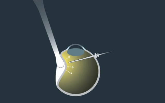 Simplifying Surgery with Swiss Precision