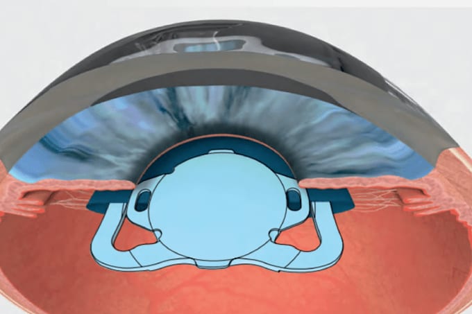 Taking Full Advantage of Automated Capsulotomy