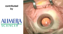 Discussion of NICE Guidelines for the Treatment of Diabetic Macular Edema in Clinical Practice with the Fluocinolone Acetonide Intravitreal Implant