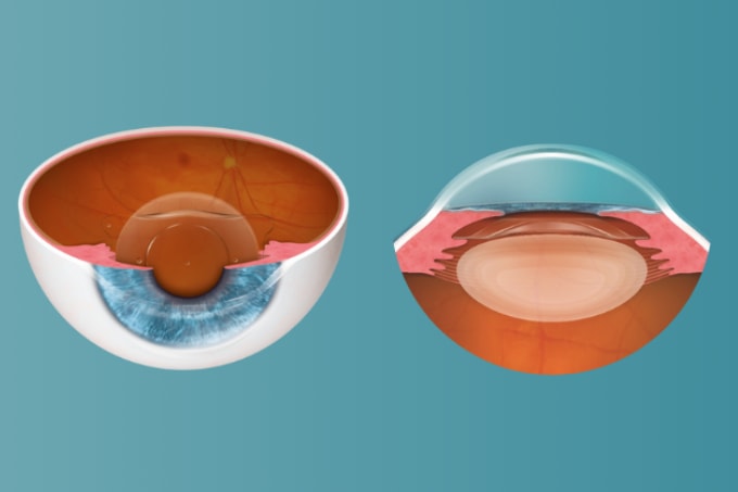 EVO ICL - A Global Paradigm Shift in Refractive Surgery