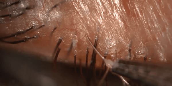 Demodex: Innocent or Guilty in Blepharitis?