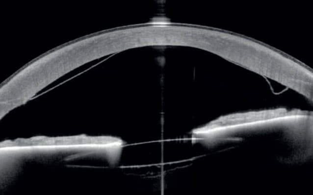 Revolutionary Anterior Segment Diagnostics: It's in the Image