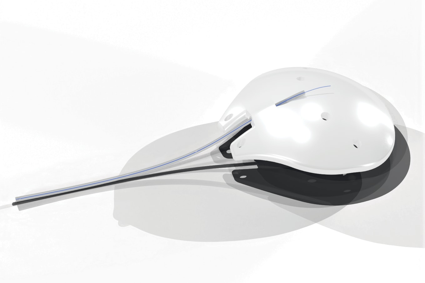 A Clearer Path to Glaucoma Surgery