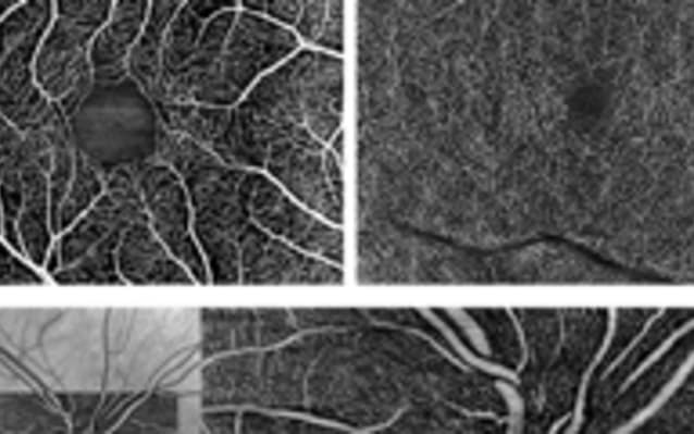 Advancing OCT Angiography