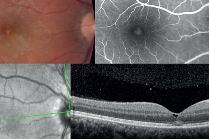 The Beauty of Choroidal Clarity