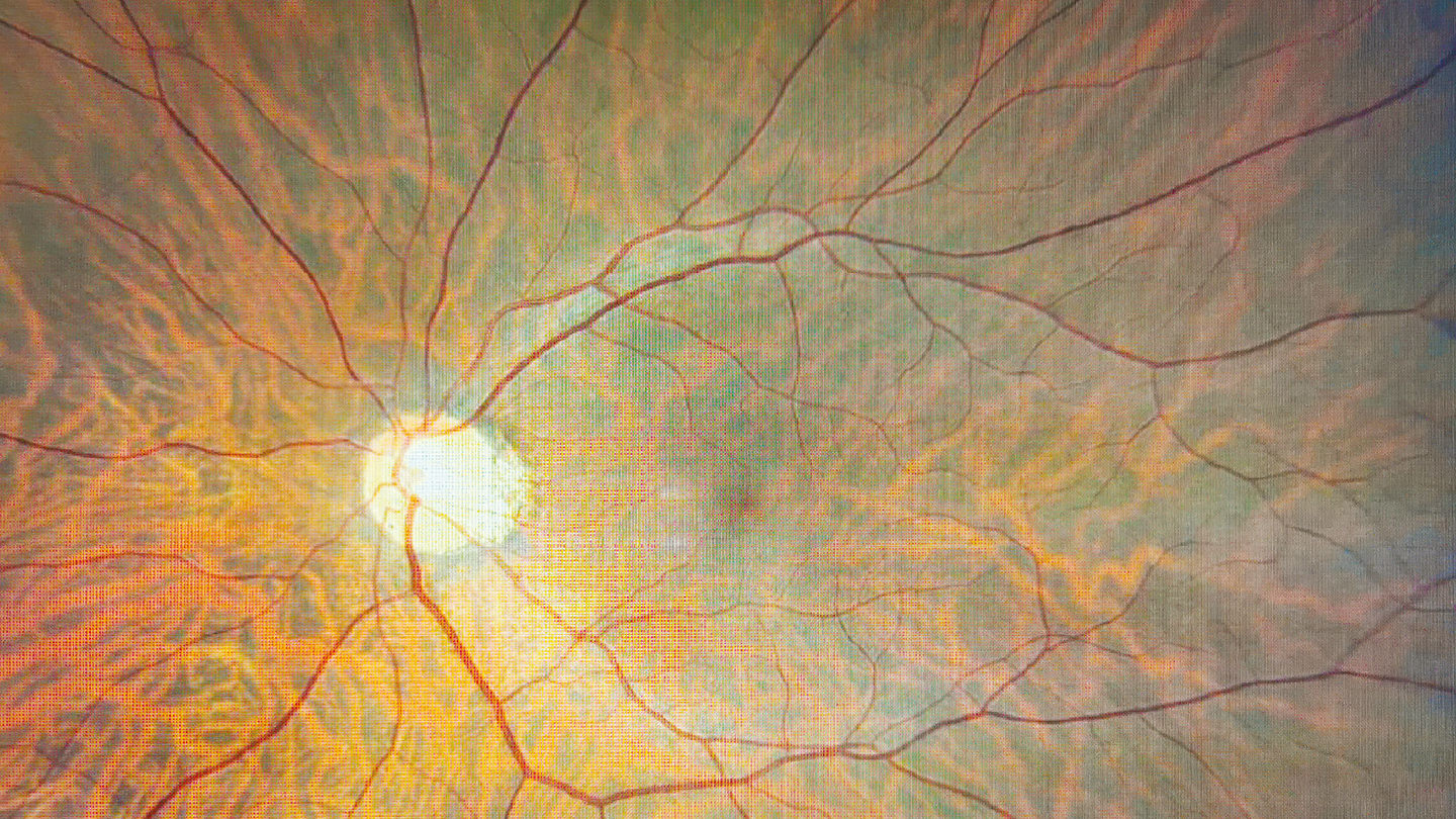 More Than Nerves: Rethinking NK Pathology
