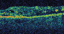 Treating Long-Lasting Diabetic Macular Edema