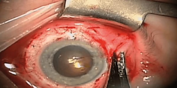 Scleral Buckling 101
