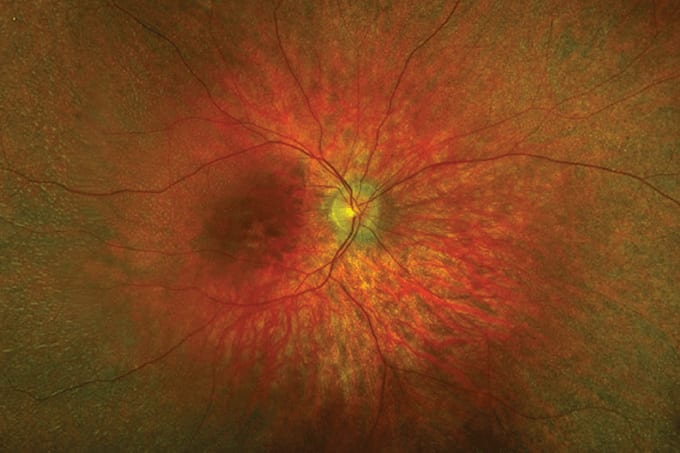 Retinal Disease and False Hope