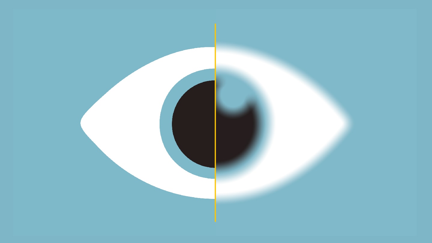 Inhaler Cataract Risk