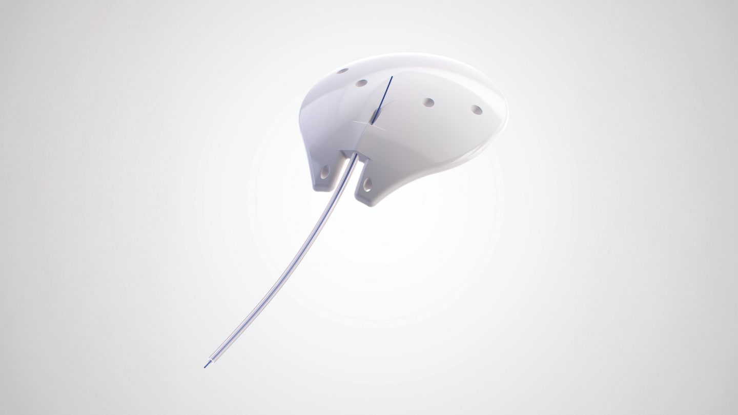 Introducing the Ahmed ClearPath® ST: Evolving Design for Evolving Needs in Glaucoma Surgery