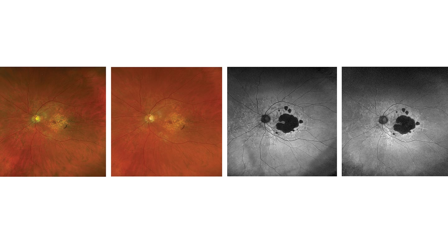 The Power of Ultra-widefield Imaging and Navigated Peripheral OCT