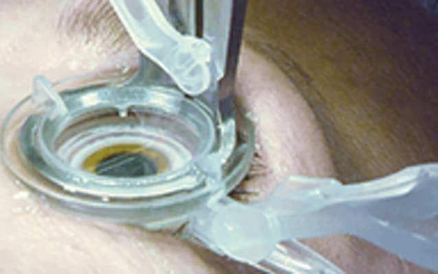 Look into the Intelligent Approach to Cataract Surgery
